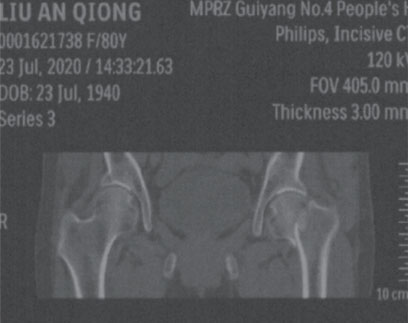 股骨颈及股骨粗隆间病理性骨折与伤病关系鉴定案例